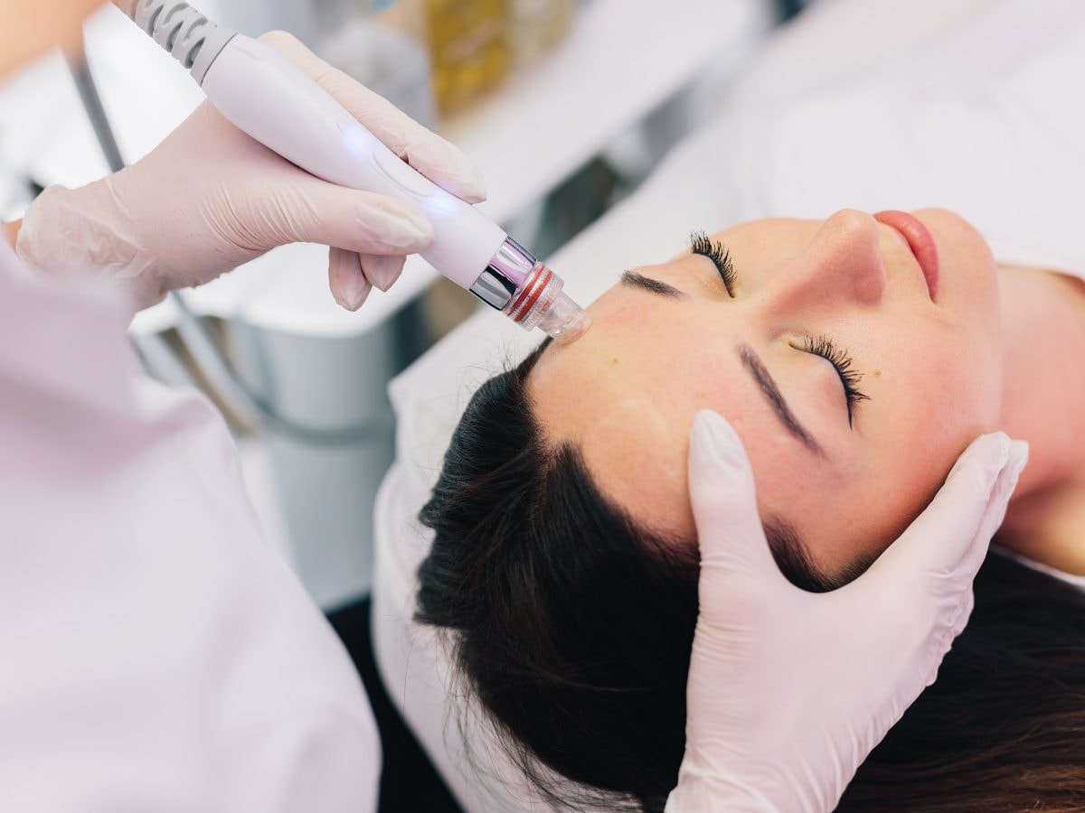 Tratamiento con pluma de microneedling